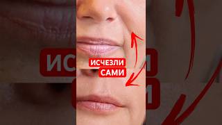 Как убрать носогубные складки за 7 дней?
