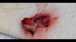 Radicular Cyst (Periapical Cyst)