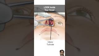 Nasal obstruction due to turbinate hypertrophy #doctor #nasalcongestion #anatomy #animation