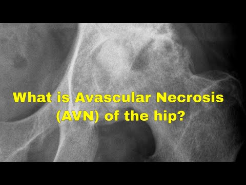 What causes avascular