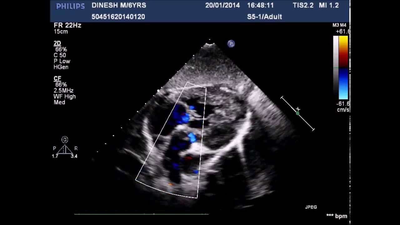 Double chambered right ventricle demonstrated by echocardiograghy - YouTube