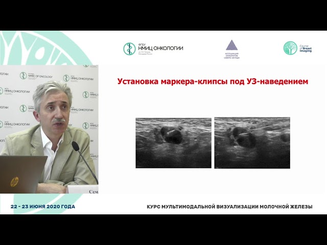 Биопсия сигнальных лимфатических узлов, виды маркировки с помощью различных диагностических методов