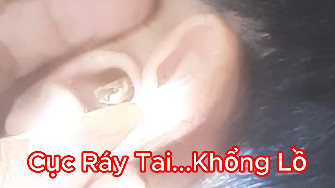 Lấy Ráy Tai Phê Pha: Cục Ráy Tai Siêu To Khổng Lồ: Quá Khủng Khiếp ...