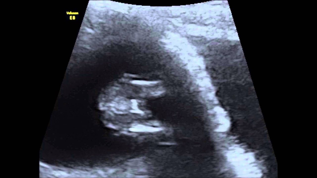 13 неделя коричневые. Boy or girl Ultrasound 20 weeks.