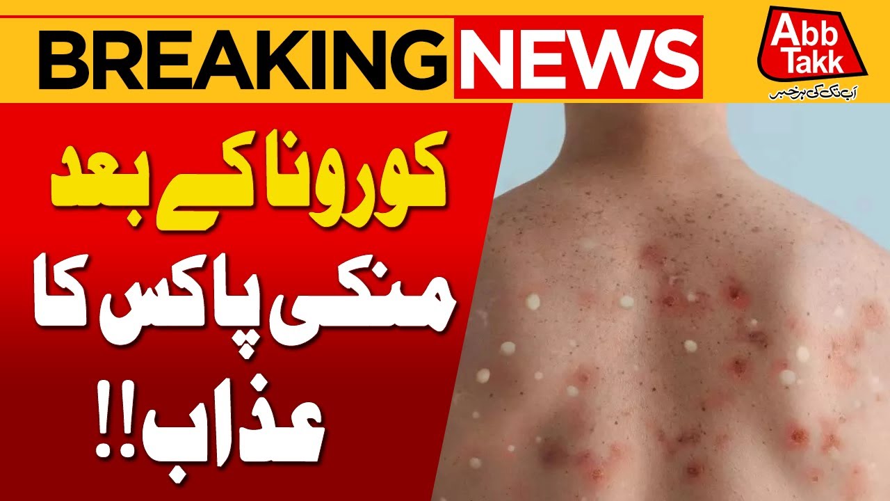 Monkey Pox Spreading In Pakistan | High Alert | Breaking News | Abbtakk ...