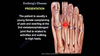 Freiberg's Disease - Engsub