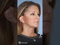 Amazing before and after from necklift  facelift by dr kevin sadati plasticsurgery