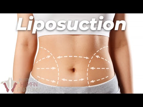 Vídeo: La liposucció tumescent fa mal?