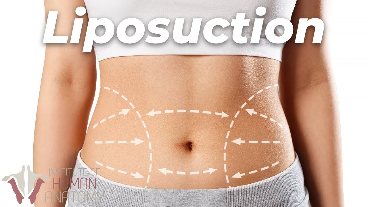 This Is What Happens During a Liposuction