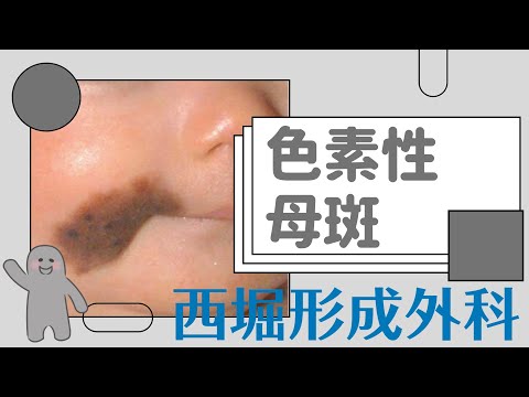 西堀形成外科】黒あざ_色素性母斑について - YouTube