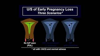 Full Sonography of early pregnancy loss News