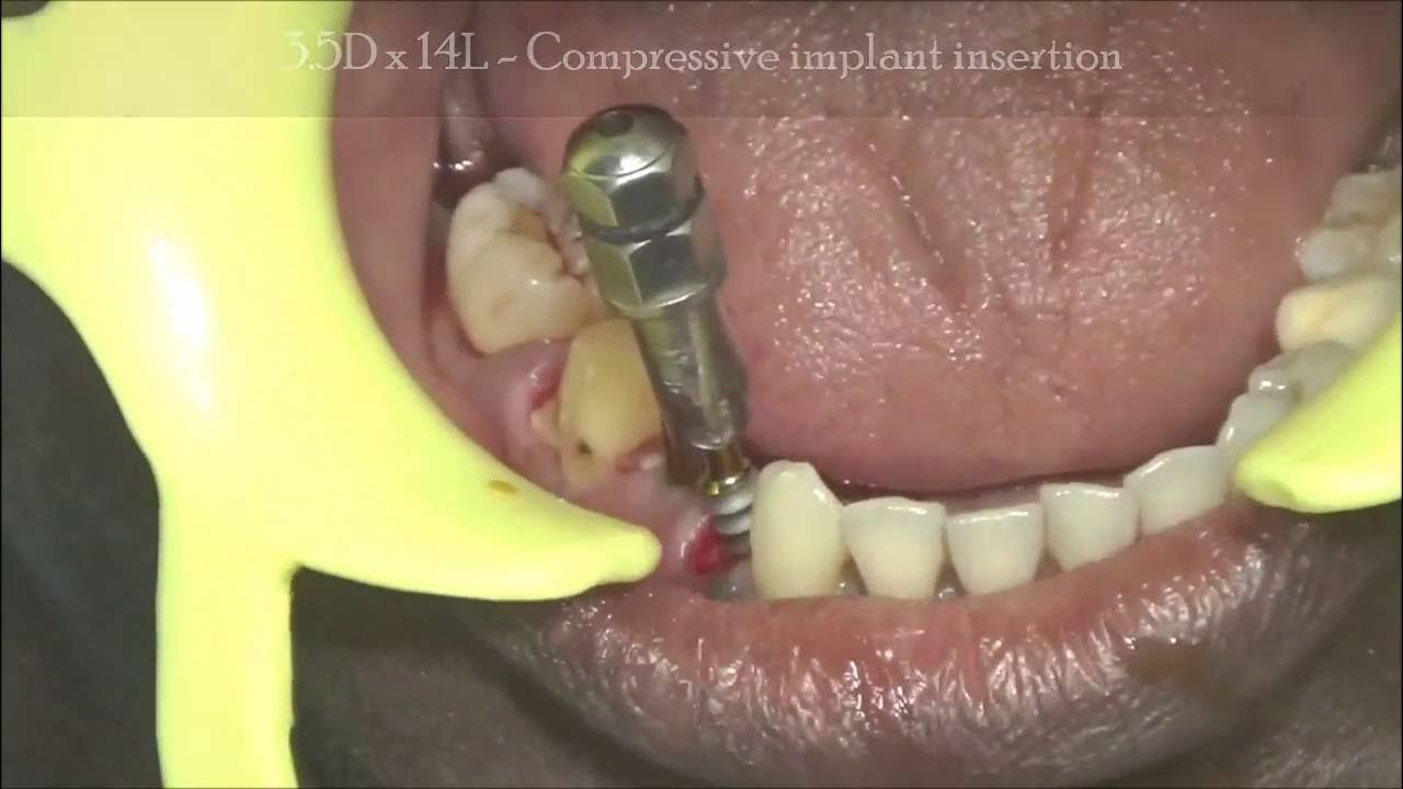 Fractured lower premolar extraction and replacement with immediate