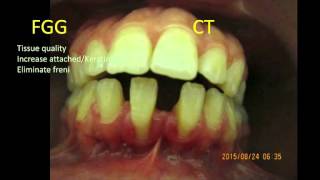 Recession on lower incisors. FGG or CT (PART 2)