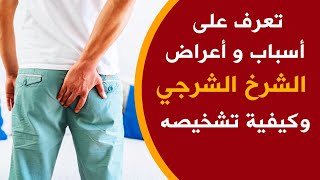 الشرخ الشرجي - اسباب و اعراض الشق الشرجي Anal Fissure لا يفوتك هذا الفيديو قبل العلاج