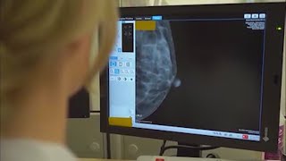 Northwestern Medicine Doctor Warns New Mammogram Guidelines Could Impact Survival Rates