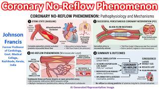 Coronary No-Reflow Phenomenon