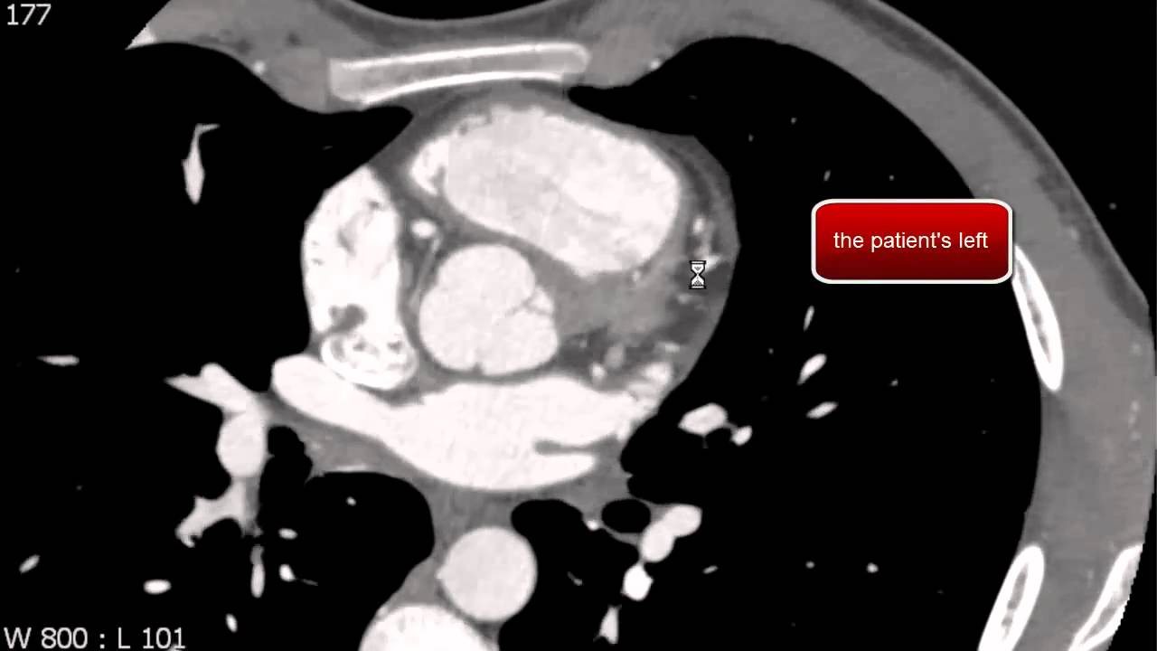 Left Anterior Descending Coronary Artery Anatomy on Coronary CTA - YouTube