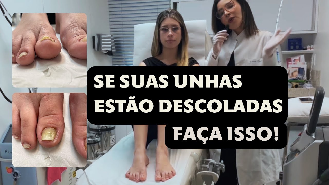 UNHA DESCOLADA: O que fazer e como tratar ! - YouTube
