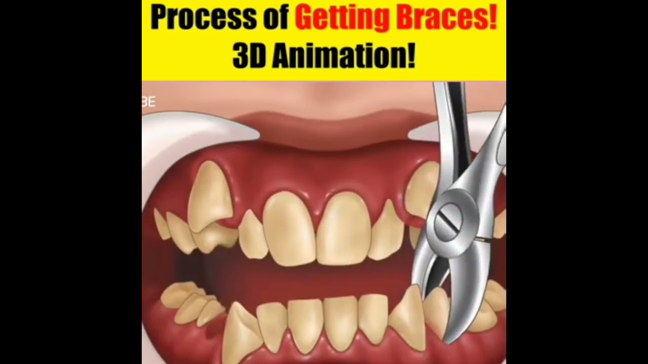 Process Of Getting Braces ! 3 D Animation YouTube