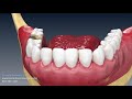 Extraction and socket graft animation