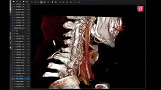 V6 - Bee viewer for Mac quick start by Barry's Recovery (ACDF & Jugular Vein Compression) 490 views 6 months ago 3 minutes, 12 seconds