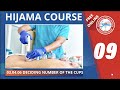 09 online hijama  leech therapy course determine location of the cups drn suleyman gok