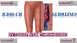 What is DVT DVT Deev Vein Thrombosis ICD10-CM Guidelines Hindi
