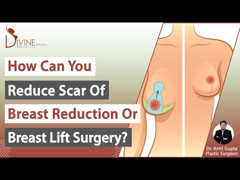 Breast Reduction 