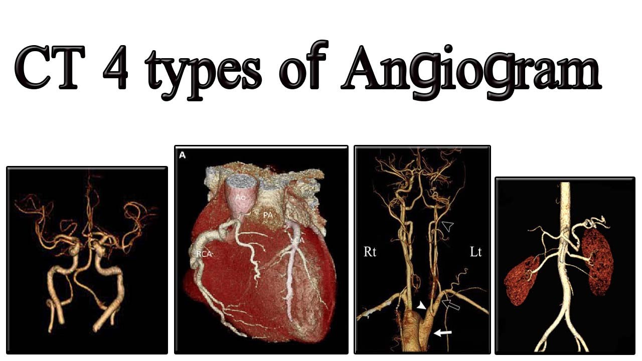 CT Angiogram Brain,carotid,abdominal,coronary 128 slice full technique Siemens 16 slice