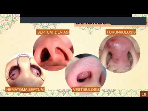 Video: Kelengkungan Septum Hidung - Bahaya Yang Tidak Dapat Dilihat Pada Anak