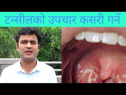 Tonsillitis in Nepali|Deepak Poudel|doctor sathi