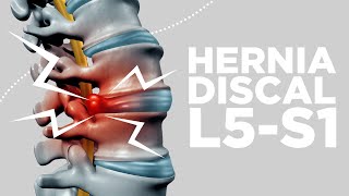 HERNIA DISCAL L5S1 síntomas y soluciones