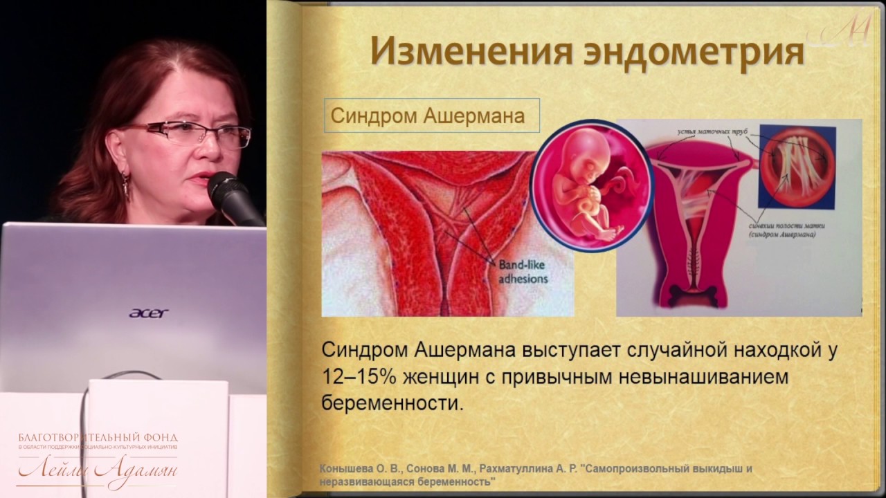 Прерывание беременности 3 недели. Самопроизвольный выкидыш на раннем сроке. Самопроизвольное прерывание беременности на ранних сроках.