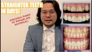 Crooked to Straight Teeth in days | Biomimetic Crowns and Veneers | Apostol Dental Philippines