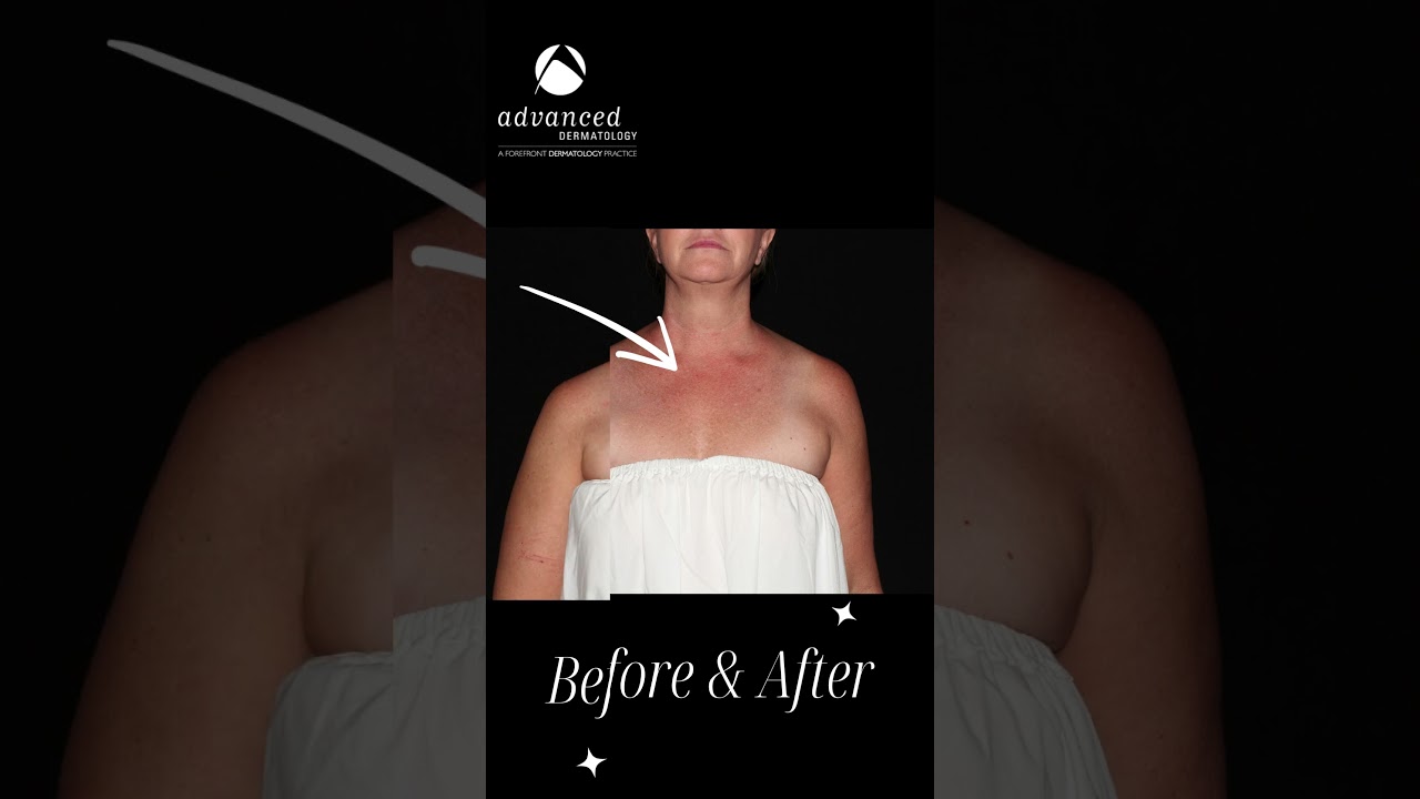 Photorejuvenation Targets Redness! 