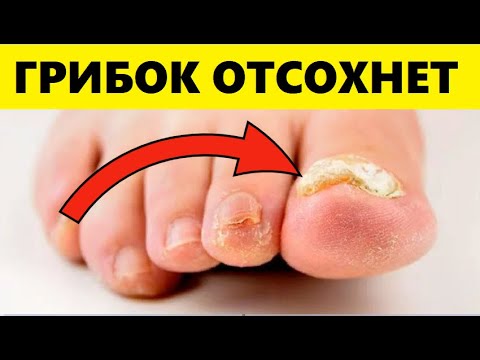 Лекарство От Грибка Растёт у Вас Под Окнами! Грибок Стоп и Ногтей Как Огня Боится Этого...