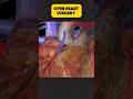 Open Heart Surgery Explained