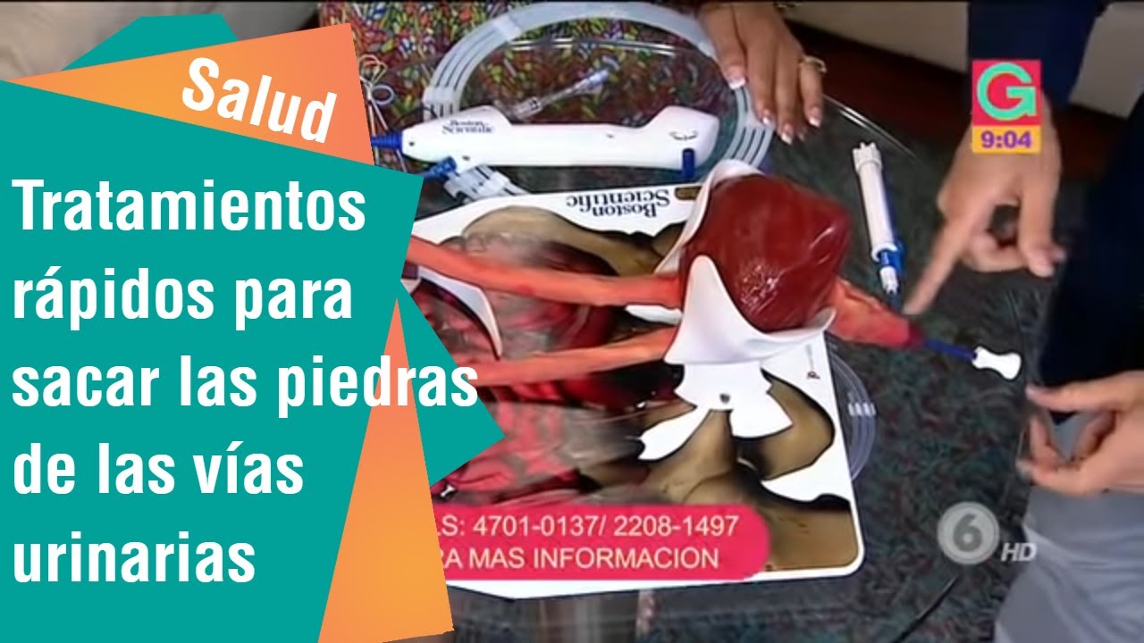 como sacar las piedras en los rinones