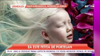 Nariyana, O Fetiță De Opt Ani, Suferă De Albinism. Boala A Transformat-O Într-Una Dintre Cele Ma