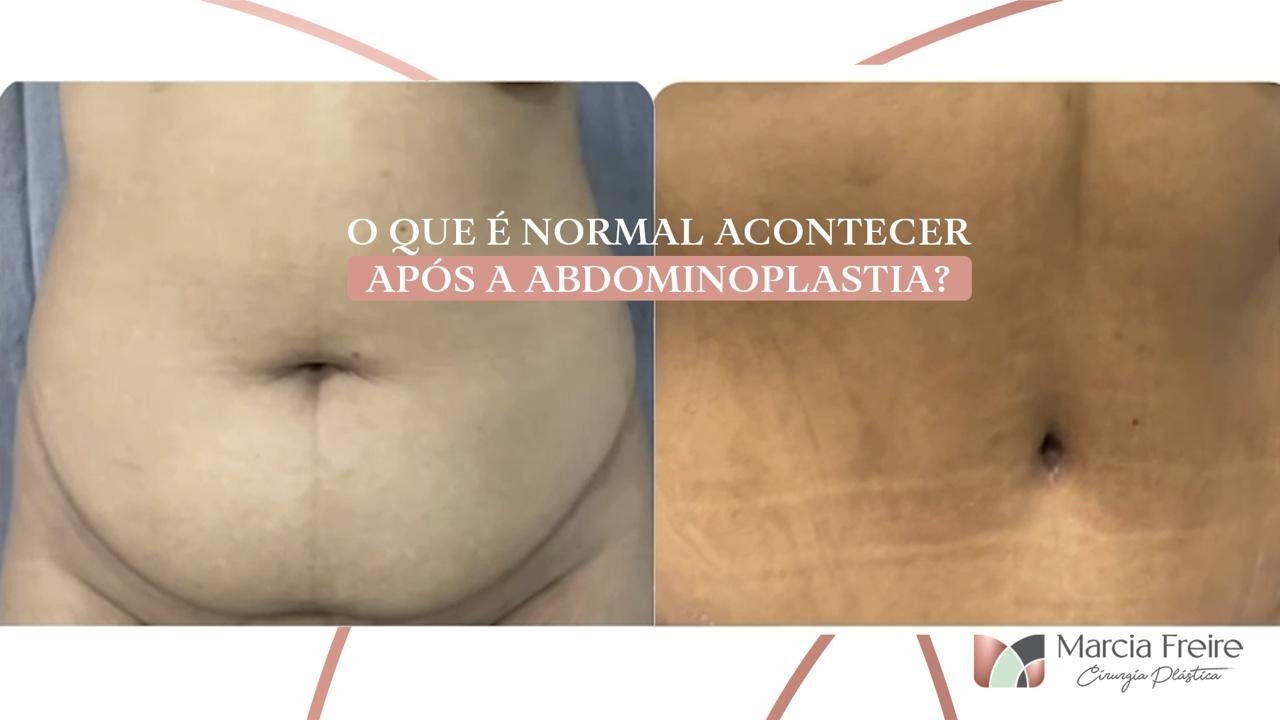 O QUE É NORMAL ACONTECER APÓS ABDOMINOPLASTIA