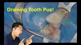 Tooth Abscess Draining Pus!!  + Free Endo Gear Guide