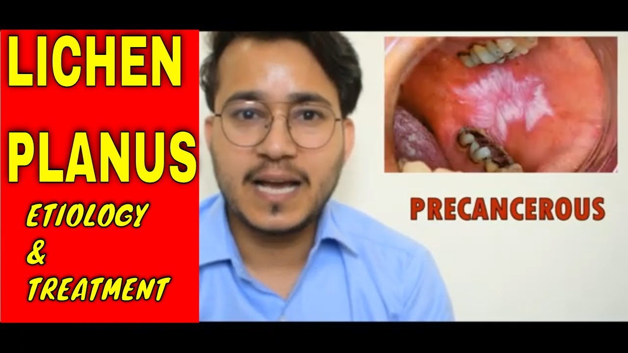 Oral Lichen Planus Treatmentलाइकेन प्लानस का इलाज ETIOLOGY AND