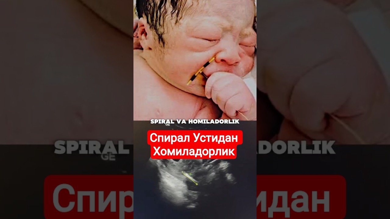 Спираль Устидан Хомиладорлик #drshahnozahakimova #спираль #homiladorlik