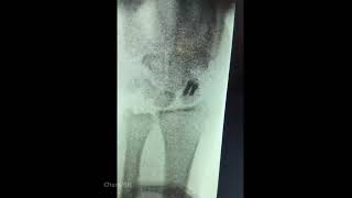 Scaphoid fracture nonunion #handsurgery #scaphoidnonunion