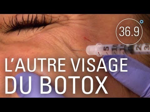 Vidéo: Botox: Empoisonner Votre Corps? Sécurité, Utilisation, Effets à Long Terme