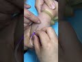 Injection Technique Made Simple | Types of Needle Injections You Need To Know 2
