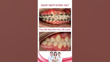 Thay đổi hàm răng chen chúc khấp khểnh | Bác sĩ Thu Gia Lâm