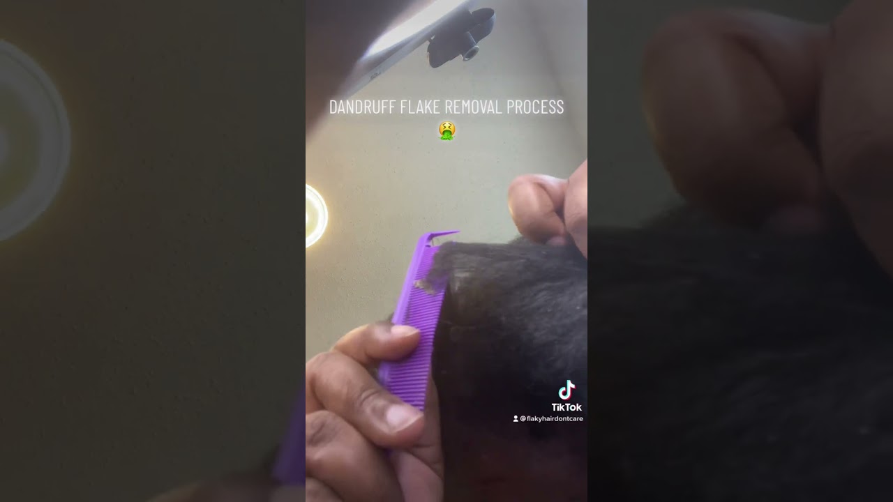 DANDRUFF SCALP SCRATCH ‼️Look at those flakesss 😂