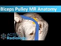 Biceps Pulley Anatomy on MRI