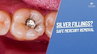 Are Silver Fillings Bad? Safe Mercury Filling Removal